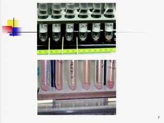 Le dépistage de la trisomie 21 par le test combiné du 1er trimestre au CHU de Bordeaux : nos modalités, bilan et difficultés