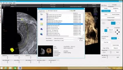 chirurgie de la cavité utérine avant apres
