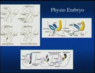 Un kyste particulier : hydrocolpos sur hemivagin borgne