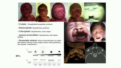 Le cerveau de la face › Anomalies cérébrales associées à des anomalies de la face