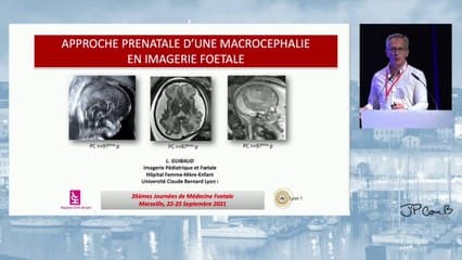 Approche prénatale d’une macrocéphalie en imagerie foetale