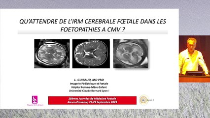 Qu’attendre de l’IRM cérébrale fœtale dans une fœtopathie à CMV