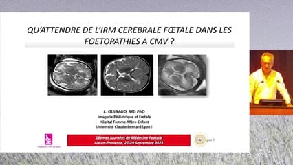 Qu’attendre de l’IRM cérébrale fœtale dans une fœtopathie à CMV