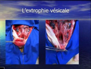 Extrophie vesicale