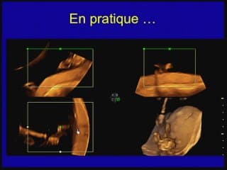 guidage échographique 4D de la coagulation à la pince bipolaire du cordon