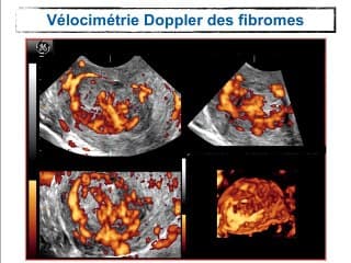 Les myomes : De l'imagerie au chirurgien