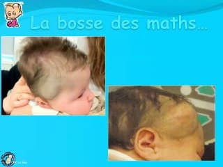 Hémangiome congénital céphalique dit  « Rich »