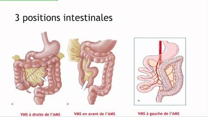 La malrotation digestive : dépister ou ne pas dépister en anténatal, telle est la question !