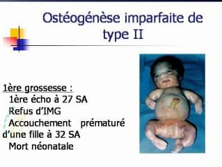 Ostéogénèse imparfaite type II