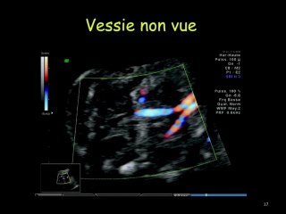 Imagerie anténatale des voiesurinaires extra-rénales, du normal au pathologique. Que doit-on dépister ? Peut-on caractériser les anomalies des voies excrétrices urinaires in utero ?