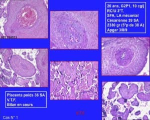 Le placenta L'oeil du foetopathologiste