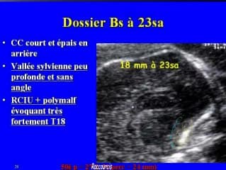 Biométrie et anomalies du corps calleux