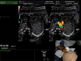L' examen du coeur : Etude détaillée des coupes des 3 vaisseaux : « live »