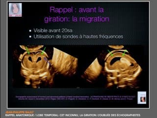 Le lobe temporal : cet inconnu - la giration : l'oubliée des échographistes