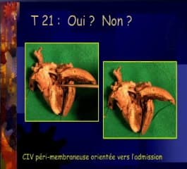 T21 avec ILVAV