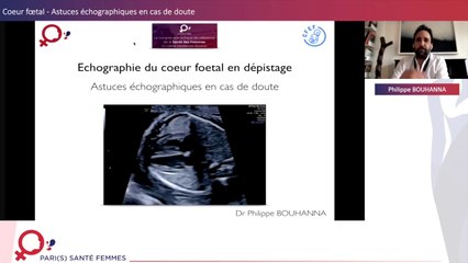 Cœur Fœtal en dépistage: Astuces en cas de doute