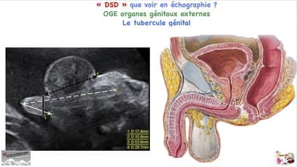 anomalies des organes génitaux échographie : que voir en prénatal diagnostic