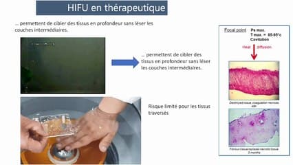 Traitement de l’endométriose rectale par ultrasons à haute intensité (high-intensity focused ultrasound / HiFU)