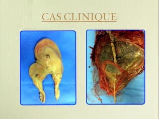 Jumeau acardiaque radiofrequence