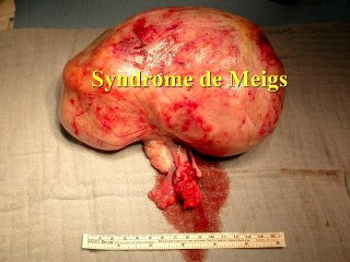Ovaire : les images des tumeurs de l'ovaire : classification et scorede gravité. Focus sur les tumeursendocriniennes : les signescliniques et l'échographie sontindissociables : une sémiologiedifficile mais accessible à tous.