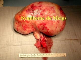 Ovaire : les images des tumeurs de l'ovaire : classification et scorede gravité. Focus sur les tumeursendocriniennes : les signescliniques et l'échographie sontindissociables : une sémiologiedifficile mais accessible à tous.