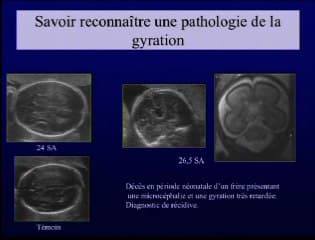 La gyration : ce que vous devez savoir en échographie et en IRM