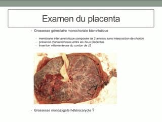 Discordance de sexe dans une grossesse gémellaire monochioriale biamniotique : hypothèses physiopathologiques.
