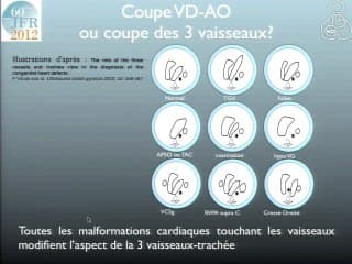 Coupe VD-AO ou coupe des 3 vaisseaux ?