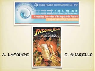 MAPCA major aorto pulmonary collateral arteries