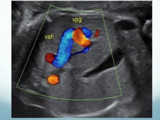 Fistules porto-sus-hépatiques : Du diagnostic prénatal au devenir néonatal. A propos de 12 cas