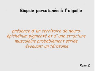 Masses rétropéritonéales foetales
