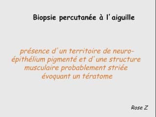 Masses rétropéritonéales foetales