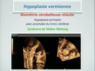 Existe-t-il une biométrie pratique au-delà de la mesure du BIP/PC ? : La mesure du diamètre transverse du cervelet est-elle suffisante
