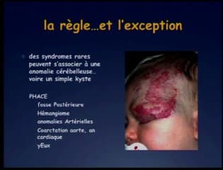 Que dire devant une suspicion de dysgénésie vermienneou une hypoplasie cérébelleuse ?