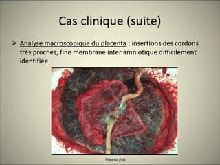 Rupture spontanée des membranes inter-amniotiques. A propos d’un cas et revue de la littérature