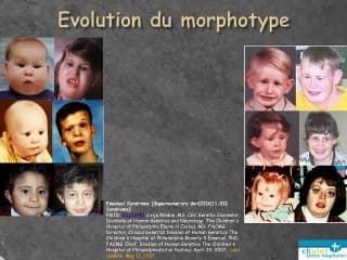 Syndrome d’Emanuel