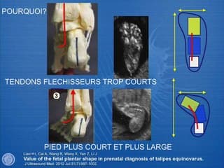 Le pli plantaire transverse