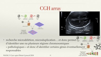 Cerveau foetal II : c’est trop gros ! Dilatations ventriculaires