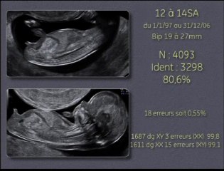 Sexe foetal et échographie du 1er trimestre de la grossesse