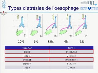 Atrésie de l'oesophage