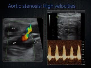 le coeur foetal  ( en ANGLAIS )
