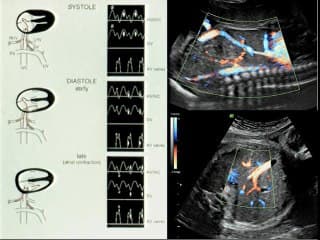 L'échographie de dépistage « revisitée »: le Doppler.