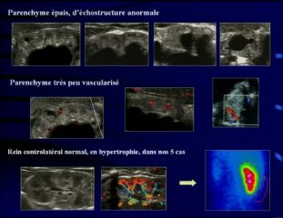 Urinome et uropathie malformative