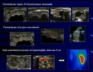Urinome et uropathie malformative