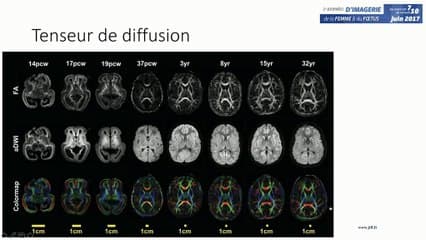 Evaluation de la maturation cérébrale : giration, migration et apports des nouvelles techniques IRM
