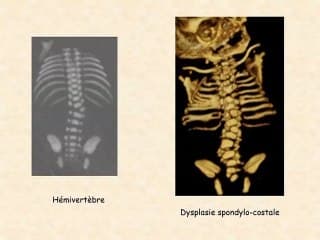 Découverte d'un fémur court