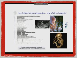 Anomalie d’un membre, du rachis, RCIU