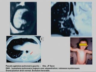 Hypoplasie et agénésie pulmonaire Les données postnatales