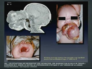 La sphère ORL : les situations qui nécessitent une intubation, une réanimation en salle de travail