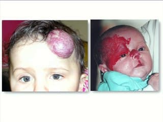 Syndrome PHACE : grave ou pas grave ?